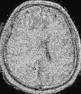 CT mozgu Liečba bakteriálne meningitídy Cefalosporíny 3.