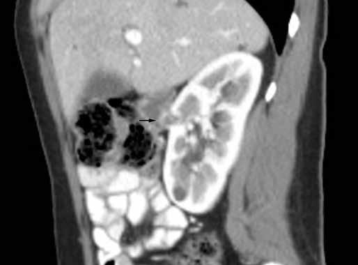 Abdominal CT was performed due to elevated liver enzymes in order to exclude hepatopathy.