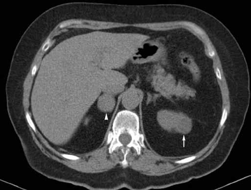 Obr. 2A Obr. 2B Obr. 2C Obr. 2. Onkocytom nesprávně popsaný jako maligní léze. 73letá žena po hypertenzní krizi. CT bylo provedeno k vyloučení feochromocytomu.