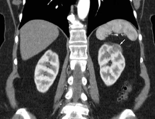 A 73-year-old woman after a hypertensive crisis. CT was performed to exclude pheochromocytoma.