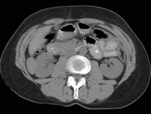 Obr. 3A Obr. 3B Obr. 3C Obr. 3. Angiomyolipom nesprávně popsaný jako maligní léze. 50letá žena. CT bylo provedeno z důvodu bolestí břicha vlevo.