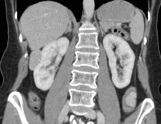 Příčina bolestí nebyla při CT objasněna, ale v parenchymu pravé ledviny byla náhodně nalezena ložisková léze.