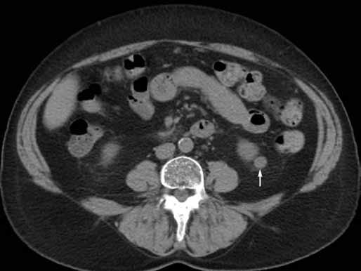 A 57-year-old woman, CT was performed to investigate newly diagnosed hypertension without subjective problems.