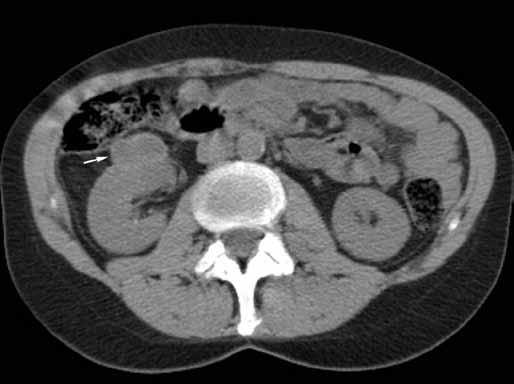 Příčina bolestí nebyla zjištěna, ale na dolním pólu levé ledviny byla náhodně nalezena cystická léze velikosti 13 (šipka).