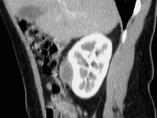 Cause of the pain was not found, but an incidental finding of a 13 lesion (arrow) growing from the lower pole of the left kidney was revealed.