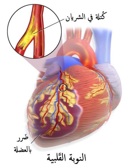 Rozlišujeme dvě frakce a to LDL a HDL cholesterol, nebo přesněji lipoproteiny přenášející cholesterol LDL (low-density lipoproteins) transportují cholesterol z jater do periferních tkání aterogenní