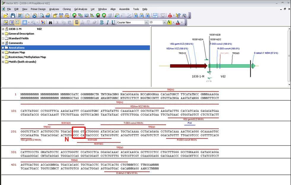 Obrázek 3: Sekvence přestavby Vd2-Dd3 vyhodnocená v programu Vector NTI. N označuje nukleotidy vložené terminální deoxynukleotidyltransferázou (TdT), specifické pro daný leukemický klon.