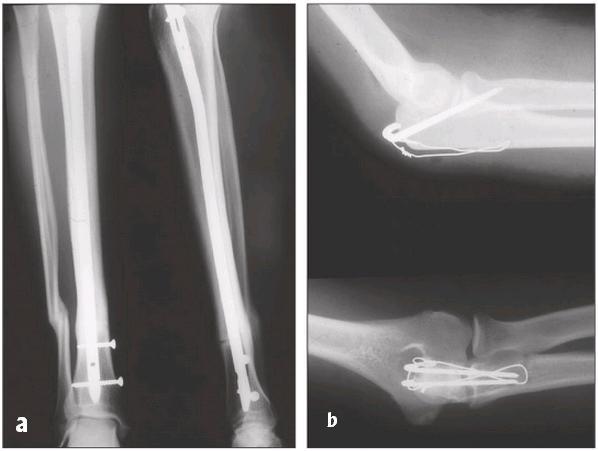 Obr. 3: a) Nitrodřeňová osteosyntéza zlomeniny tibie. b) Zlomenina okovce ošetřena tahovou cerkláží.[33] 2.