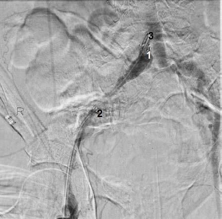 233 Obr. 1 Angiografie pravé ledviny. 1) Nefrostomie, 2) kavální filtr v dolní duté žíle, 3) pravá renální arterie, 4) břišní aorta Fig.
