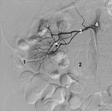 2 Angiography of the abdominal aorta and pelvic arteries.