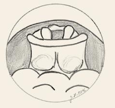 Normální nález (G), zúžení epiglottis překrývá vchod hrtanu (H). Fig. 1. Evaluation of the upper airway during wakefulness. Velum, transoral view.