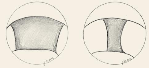 Tongue base, transnasal endoscopy. Normal finding complete view of valleculas (E), obstruction valleculas not visible (covered by the tongue base) (F). Larynx/epiglottis, transnasal endoscopy.