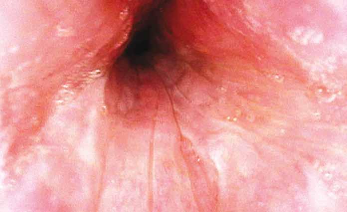 Spánková endoskopie cílená endoskopická dia gnostika u pacientů s obstrukční spánkovou apnoí Tab. 2. Vyšetřovaný soubor pacientů. Tab. 2. Baseline patient characteristics.