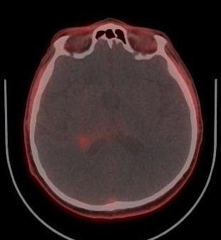 Restaging a další plán PET/CT 9/2018 Radiofarmakum FLT (fluorodeoxythymidin) ve zdravé