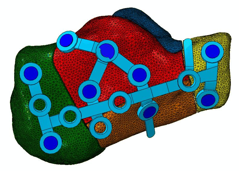 9. Příprava modelu na zatížení Základní model patní kosti spolu s dlahou importujeme do programu Abaqus. Prvním krokem je přiřazení materiálových vlastností jednotlivým částem.