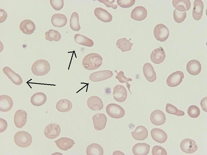 sferocytózou. Obrázek č. 13 Se změněným tvarem Ovalocyty jsou to erytrocyty ováného tvaru.