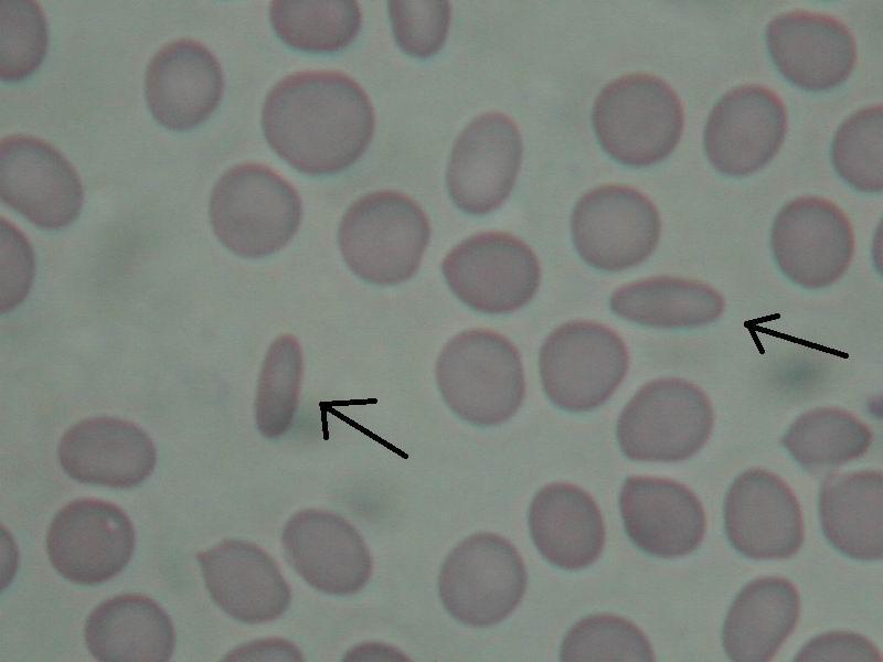 Eliptocyty- jsou podobné jako ovalocyty, jen se více podobají doutníku.