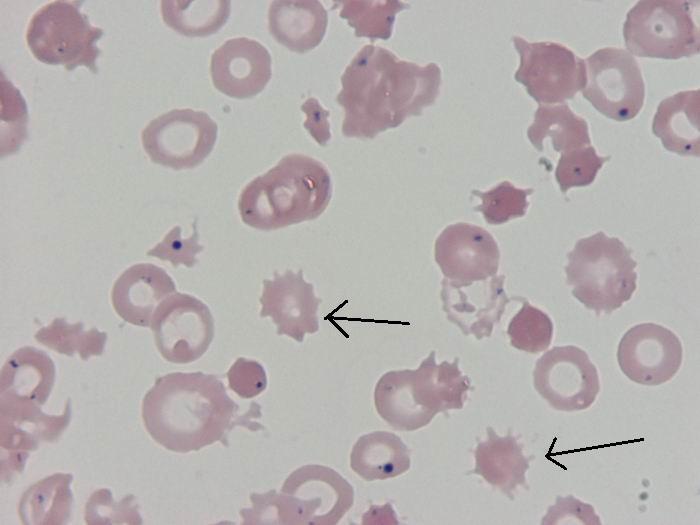 Poikylocyty jsou to krvinky velmi různého tvaru. Obvykle je nalezneme s buněčnými fragmenty nebo schistocyty. Echinocyty celý obvod je lemován mnoha krátkými a neostrými výběţky.