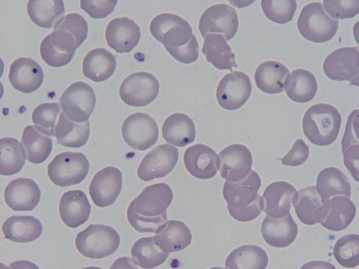 6.12.4 Buněčné inkluze v erytrocytech Jsou to různé shluky uvnitř erytrocytu. Basofilní tečkování jsou to tmavě modrá granulka o různých velikostech a tvarech.