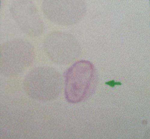 Cabotovy prstence nachází se u pacientů s megaloblastickou anémií.