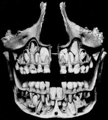 Časový průběh prořezávání dočasné dentice probíhá zpravidla od 6. do 30.