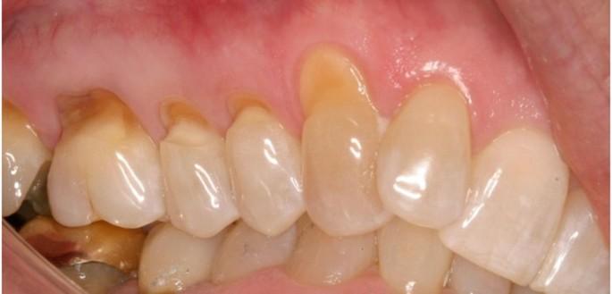Klínovitý defekt, jak už název vypovídá, je makroskopické narušení zubní tkáně ve tvaru klínu nebo trojúhelníku. Vyskytuje se v oblasti cementosklovinné hranice, hloubka defektu značí jeho závažnost.