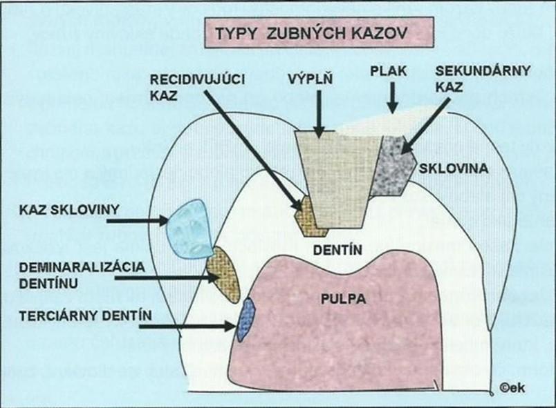 podle vztahu k vitální zubní dřeni: povrchní kaz (caries superficialis), střední kaz (caries media), kaz