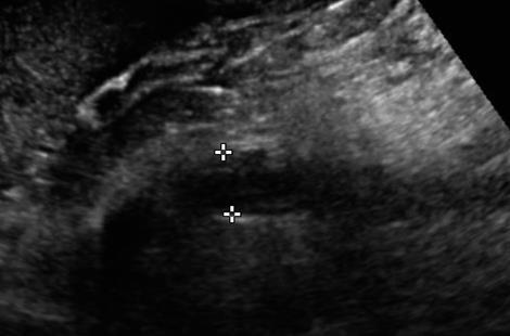 lokální narušení toku ve stenóze Stanovení hemodynamické závažnosti zvýšení rychlosti ve