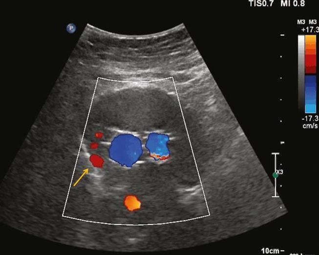 Hodnocení úspěšnosti léčby aneuryzmatu Syntetické cévní protézy při otevřených chirurgických výkonech Endovaskulární léčba se zavedením stent-graftu Trombotizace vaku aneuryzmatu, zmenšení průměru,