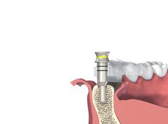 Toto je poslední krok v základní preparaci lůžka implantátu pro implantát s enoseálním Ø 3,3 mm.