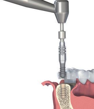 Krok 3 Vyjměte implantát z ampule Pro vysunutí implantátu z ampule stáhněte vnitřní ampuli