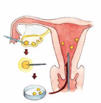 Co obnáší hormonální substituční terapie? Onkologická léčba může způsobit předčasnou menopauzu (přechod).