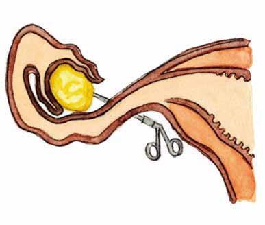 Co se dá pro zachování plodnosti udělat před protinádorovou léčbou a po léčbě? Během puberty a po ní Pokud už ve vaječnících dozrávají folikuly, můžeme před zahájením léčby několik vajíček odebrat.