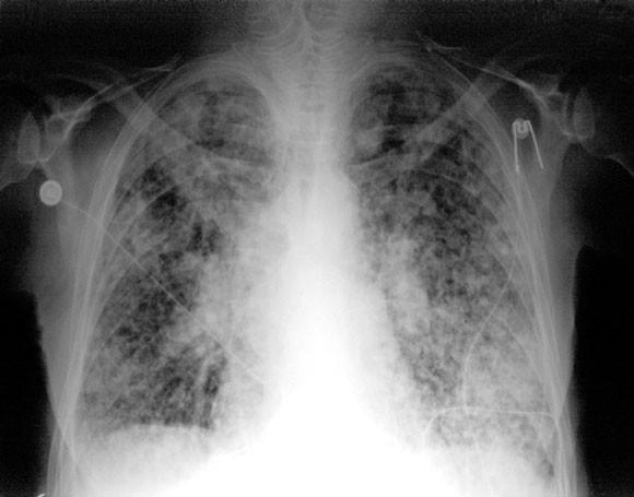 Nokardiová pneumonie se sepsí A previously well 57- year-old man 3-day history of severe dyspnoea. We conclude that N.