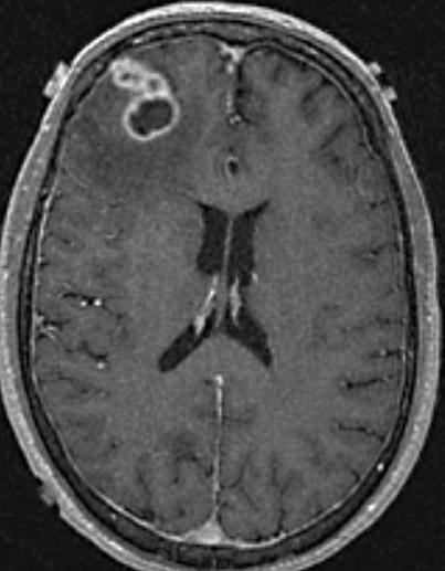 Nokardióza mozku na CT