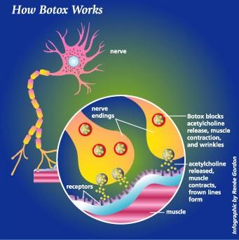 Botox: použití jedu Clostridium