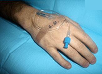 POSTUP 1 provedeme hygienickou dezinfekci rukou identifikujeme pacienta zajistíme vhodnou polohu končetiny a vypodložíme podložkou přiložíme Esmarchovo obinadlo na vybranou končetinu přibližně 5 cm