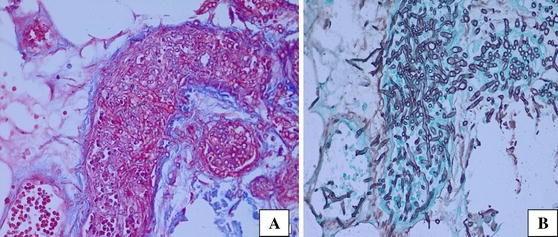Obr. 17 Hyalohyfomykóza (Fusarium spp.) - histologické vyšetření biopsie kožní léze [52] A barvení PAS; B barvení podle Grocotta 3.