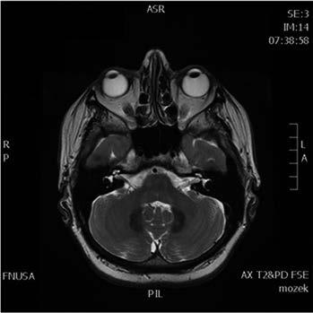 Obr. 1 4. MR mozku popsané pacientky, T2-vážené obrazy v axiálních řezech spojovány s leukodystrofií a komplikovanou formou hereditární spastické paraparézy (HSP35).