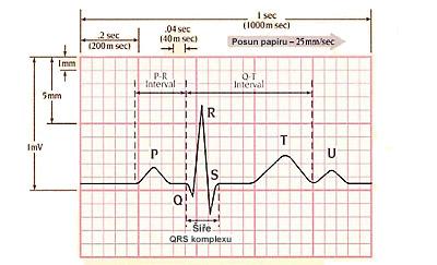Příloha E Fyziologická EKG křivka