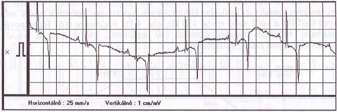 3.1.1 Kolísání izoelektrické linie Kolísání izoelektrické linie (Obr. 3.