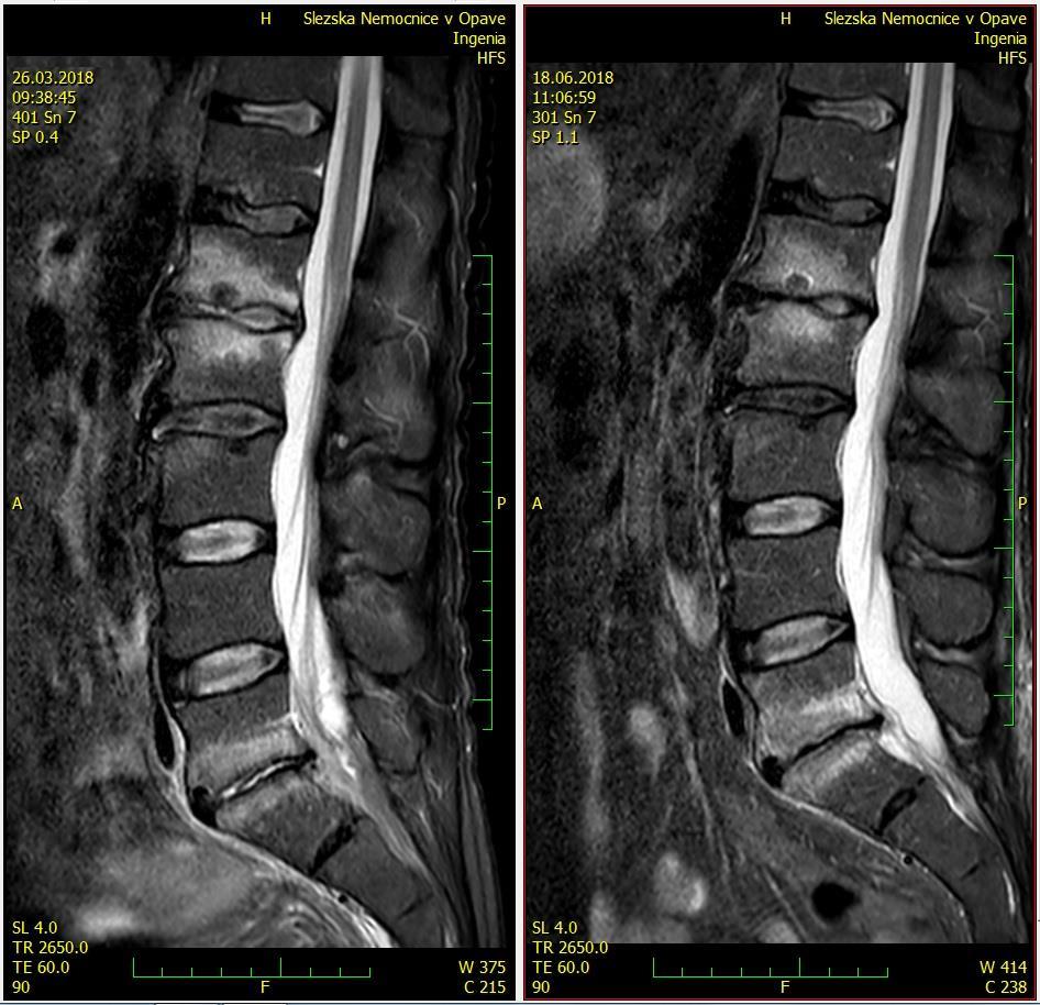 SPONDYLODISCITIDA KAZUISTIKY - PDF Stažení zdarma