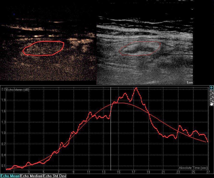 Ukázka typické křivky klidového postižení bez aktivity (PI 1,8dB, TTP 16s). Malago R, et al.