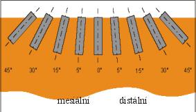Obrázek 1: Model implantátu délky 12 mm o průměru 3,6 mm zavedený v distálním nebo mesiálním směru v úhlu 0 o, 5 o, 15 o, 30 o a 45 o od svislé osy procházející středem krčku který umožňuje