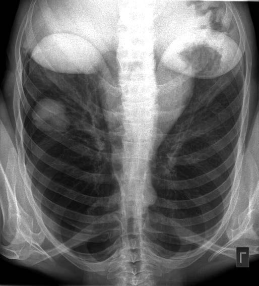 OSIMERTINIB V LÉČBĚ METASTATICKÉHO ADENOKARCINOMU PLIC S PROKÁZANOU ZÍSKANOU MUTACÍ T790M 2016 hospitalizována ve spádových zařízeních.