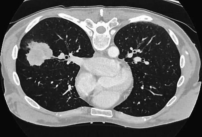 tolerovány toxicita I. stupně. Kontrolní CT hrudníku v říjnu 2016 potvrdilo výraznou parciální regresi plicního tumoru (maximální velikost 20 mm). Na současně provedeném CT mozku nebyly Obr.