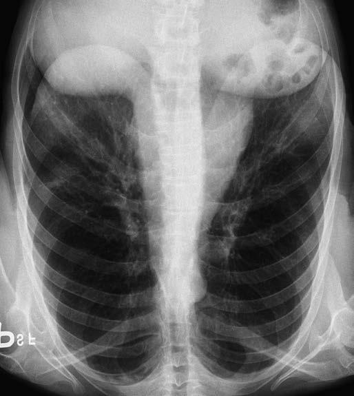 OSIMERTINIB V LÉČBĚ METASTATICKÉHO ADENOKARCINOMU PLIC S PROKÁZANOU ZÍSKANOU MUTACÍ T790M V této době jsme již měli k dispozici výsledek tzv.