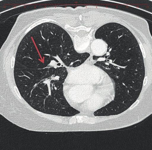 4: CT hrudníku, frontální rovina (šipka označuje pravostrannou lymfadenopatii a suspektní ložisko v S7 pravého plicního laloku) došlo k postupnému zvýšení hladin Na + a parenterální léčba byla po
