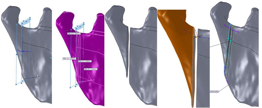 Obr. 3.38 Postup spojení rámusu a kondylu Obr. 3.39 Objemový model pravé části dolní čelisti.