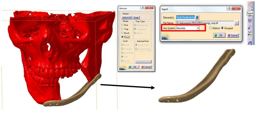 Po vyčištění je potřeba připravit jednotlivé STL modely pro implantát a dolní čelist. Rozdělení se provede postupným odmazáváním přebytečných částí modelu.